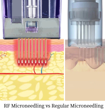 RF Microneedling vs Regular Microneedling: Which One's Better?